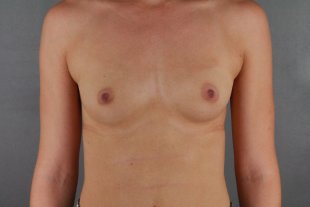 Client 48 Breast Augmentation