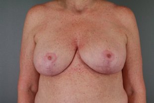 Client 52 Remove and Replace of Implants with Breast Lift