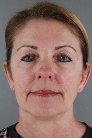 Client 67 Face lift with upper and lower eyelid lift