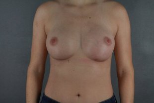 Client 66 Breast Augmentation