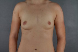 Client 66 Breast Augmentation