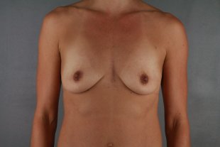Client 69 Implants and mastopexy