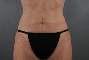 Client 71 Tummy Tuck