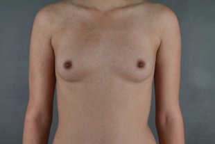 Client 73 Breast Augmentation