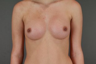 Client 73 Breast Augmentation