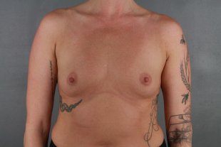 Client 79-Breast Augmentation