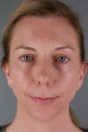 Client 89 Facial Filler, Botox and SkinCeuticals