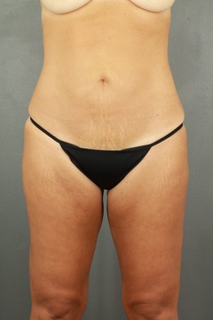 Client 90 Liposuction