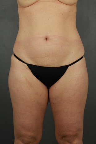 Client 90 Liposuction