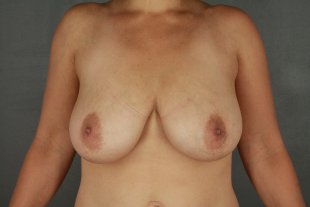 Client 105 Breast Reduction