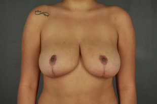 Client 112 Liposuction
