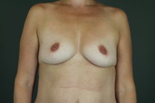 Client 115 Breast Augmentation