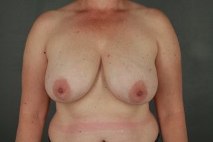 Client 116 Mommy Makeover, Abdominoplasty, Breast lift with implants, Liposuction of Flanks, upper back bra roll, and upper arms.