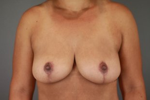 121 Mastopexy with Implants, Tummy Tuck, Liposuction Flanks.