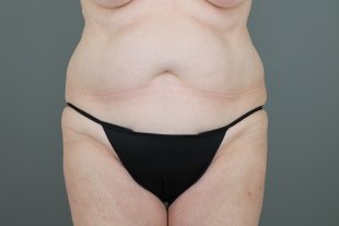 125 Scottsdale Tummy Tuck