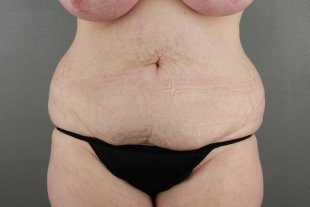 136 Tummy Tuck Scottsdale