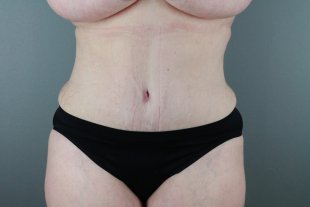 136 Tummy Tuck Scottsdale