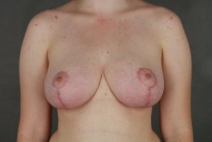 133 Breast Reduction Scottsdale