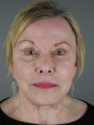 Lip Lift Patient