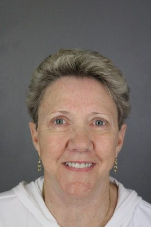 Facelift, Upper Blepharoplasty
