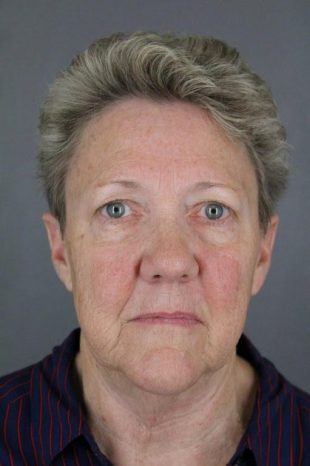 Facelift, Upper Blepharoplasty