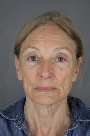 Patient I-71
