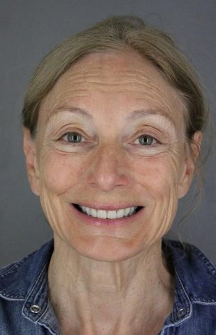 Patient I-71