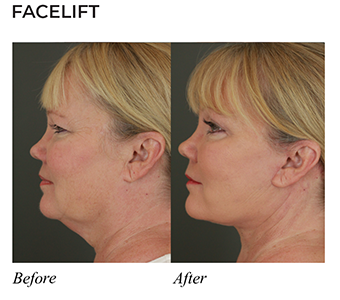 Before-and-Afters_04