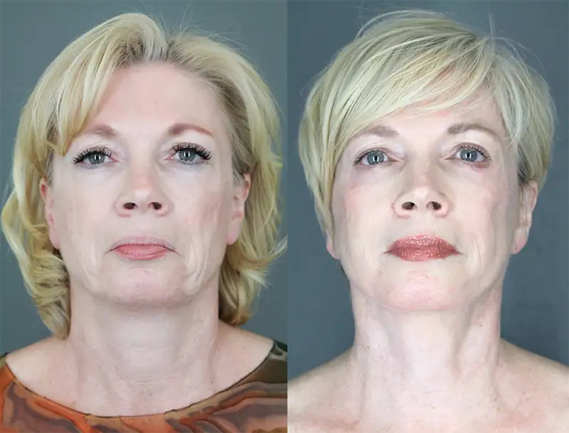 Face Lift - Eyelid Lift