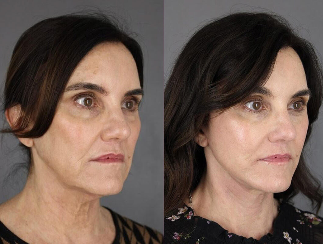 Facelift - Before and After Patient Results - 1