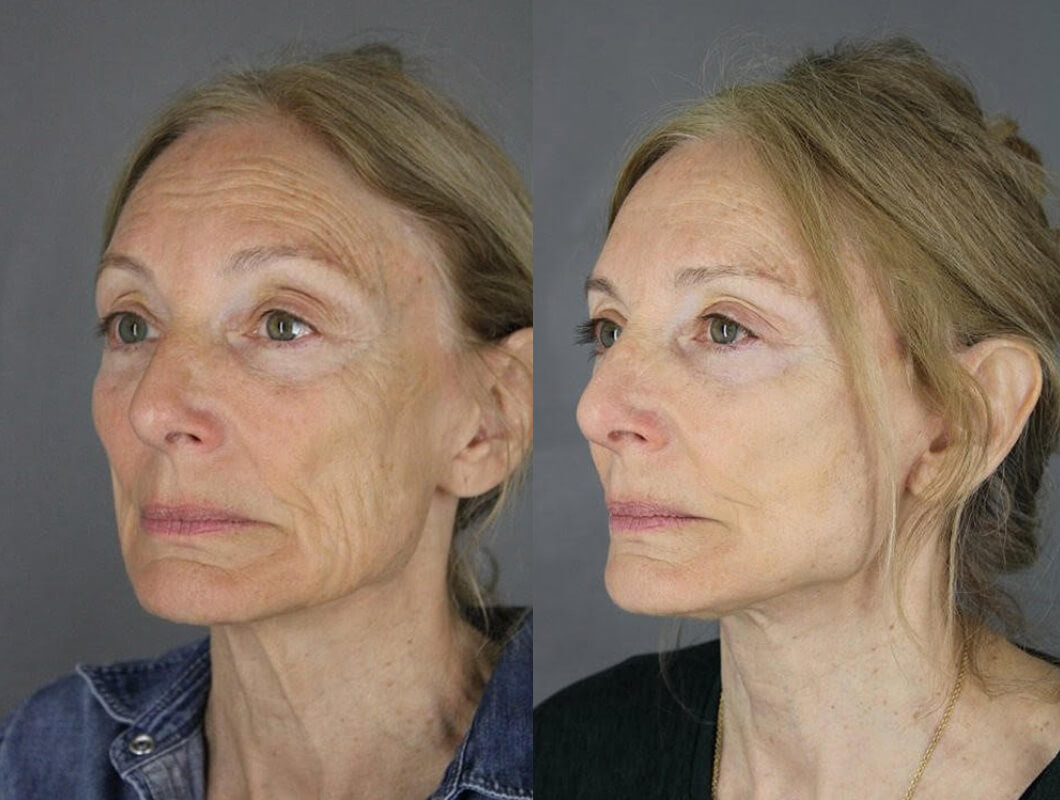 Facelift - Before and After Patient Results - 2