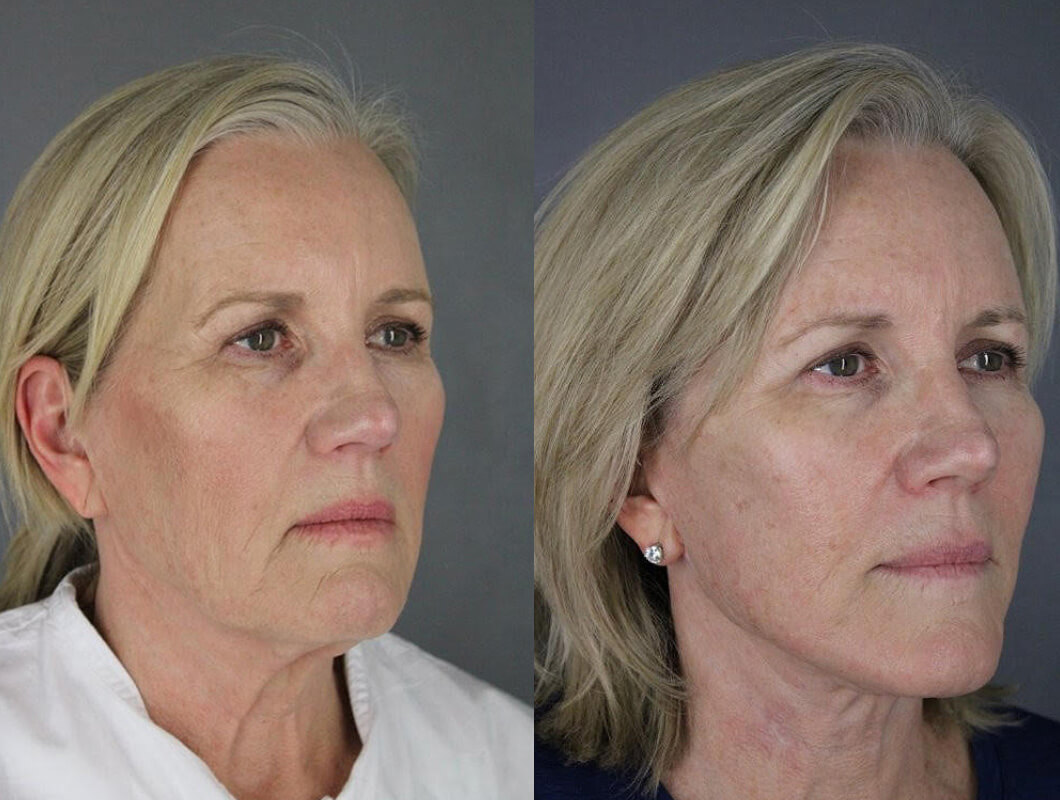 Facelift - Before and After Patient Results - 3