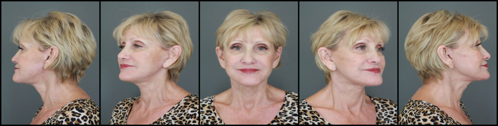 Actual Patient Results