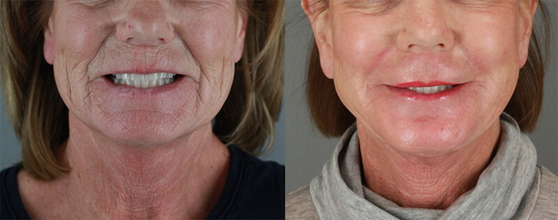 Sciton Laser - Before and After Patient Results - 1