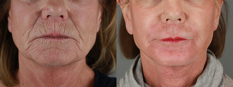Sciton Laser - Before and After Patient Results - 2