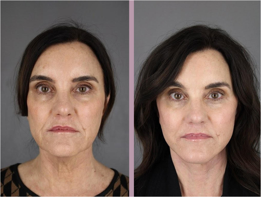 Actual Patient Results