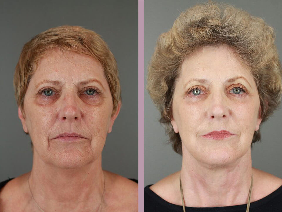 Blepharoplasty - Before and After Patient Results - 1