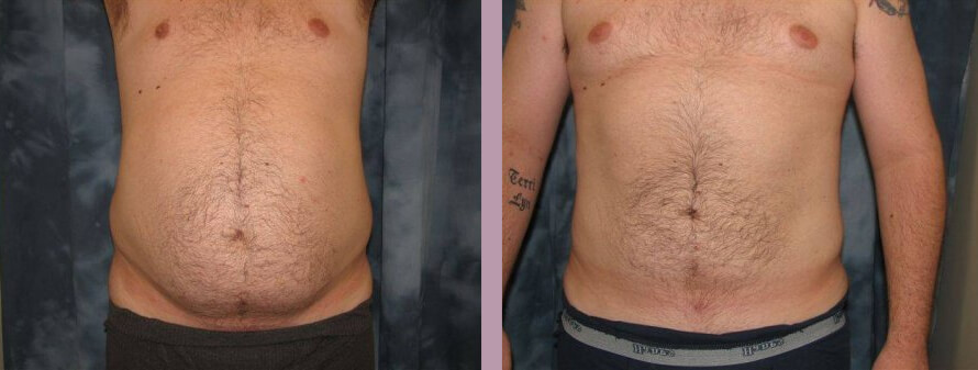 Liposuction - Before and After Patient Results - 1