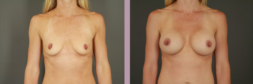 Breast Augmentation - Before and After Patient Results - 3