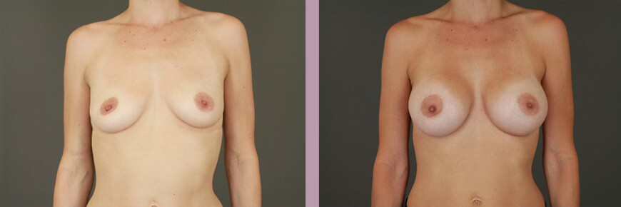 Breast Augmentation - Before and After Patient Results - 2