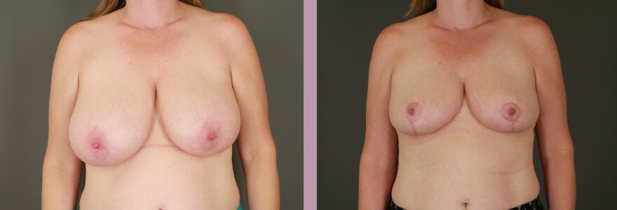 Breast Reduction - Before and After Patient Results - 2
