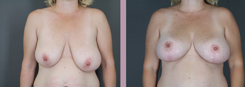Breast Lift - Before and After Patient Results - 1