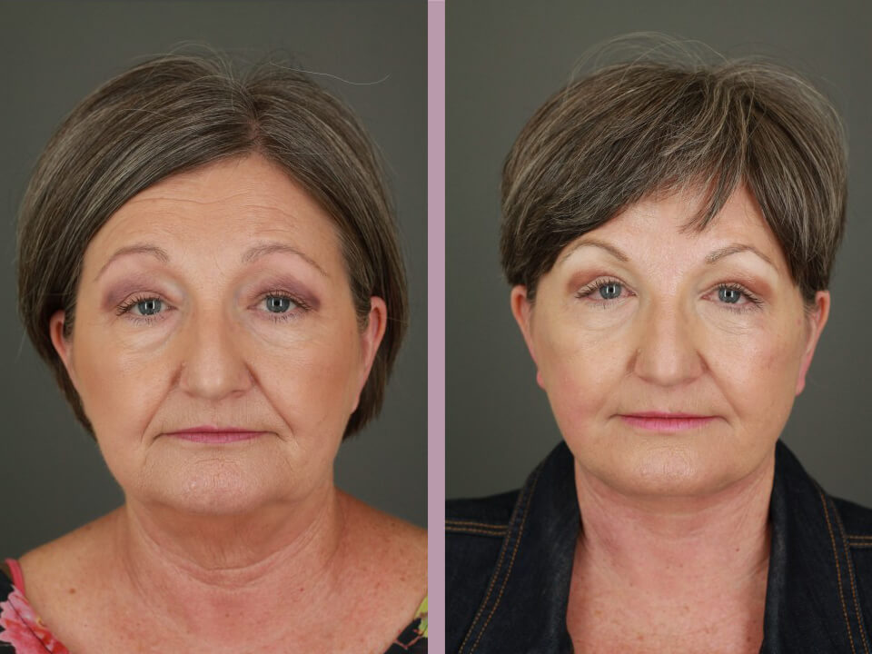 BOTOX® Cosmetic - Before and After Patient Results - 3