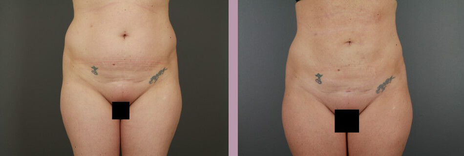 Liposuction - Before and After Patient Results - 3