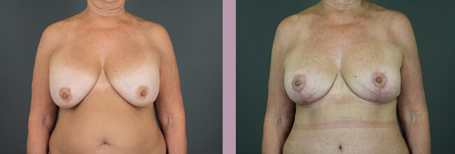 Breast Lift - Before and After Patient Results - 2