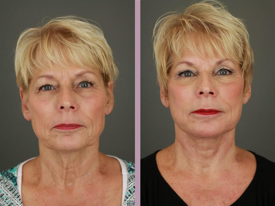Blepharoplasty - Before and After Patient Results - 3