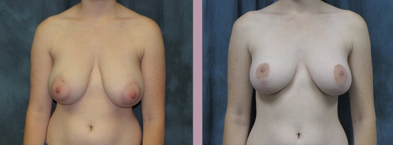 Breast Reduction - Before and After Patient Results - 3