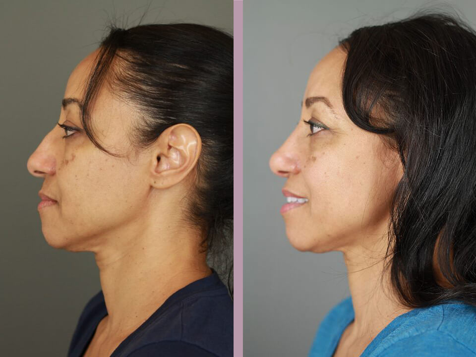 Rhinoplasty - Before and After Patient Results - 3