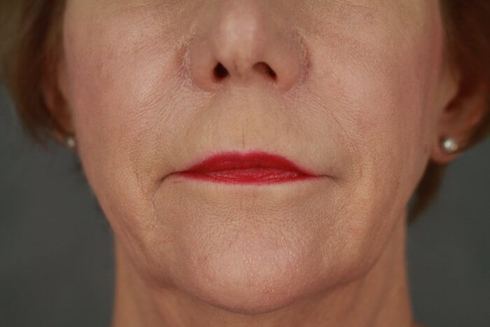 Case--3957 | After Lip Lift 6