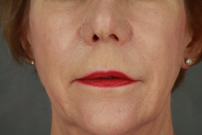 Case--3957 | Before Lip Lift 7